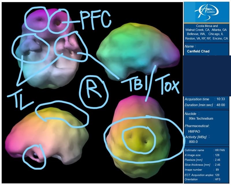 SPECT Brain Scan — TBI/Tox damage
