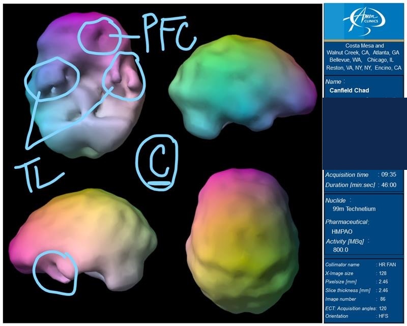 SPECT Brain Scan — Concentration state