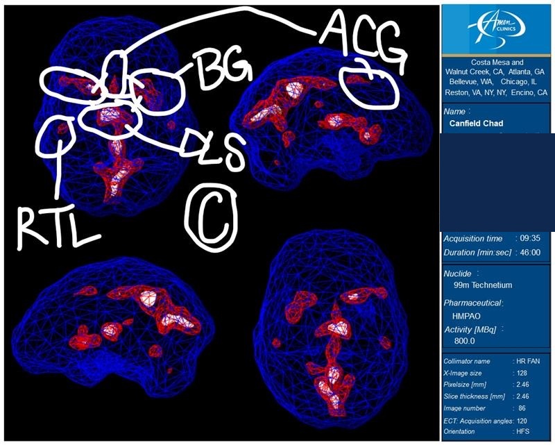 SPECT Brain Scan — Overactivity hot spots